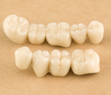 Two dental crown supported fixed bridge samples