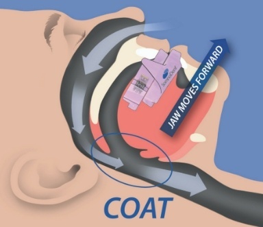 Animated representation of obstructed air way caused by sleep apnea