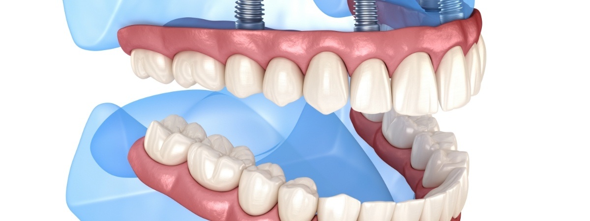 Animated smile with all on four dental implant supported denture