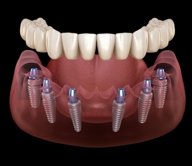 Animated smile with traditional dental implant supported denture