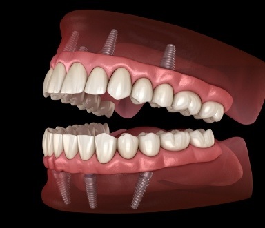 Animated smile with full upper and lower all on four dental implant retained dentures