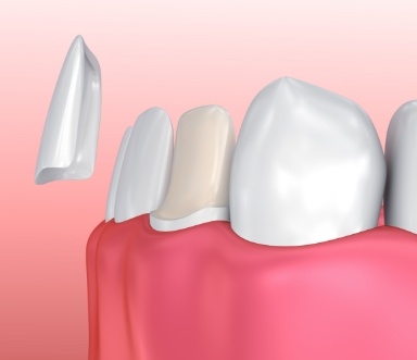 Animated smile during dental bonding treatment