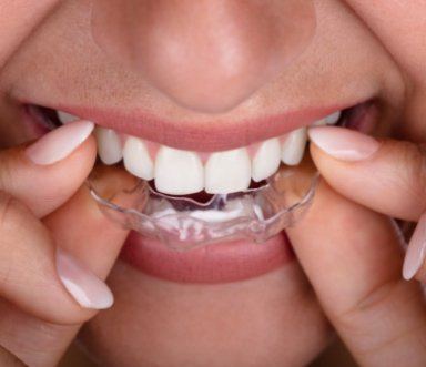 Dental patient placing an M T M aligner