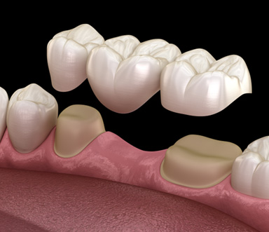 Woman giving thumbs up after comfortable tooth extractions