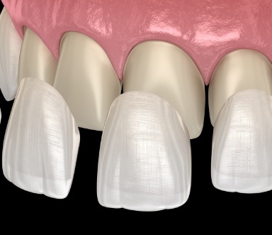 Animated smle during dental bonding treatment