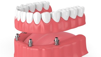 implant dentures illustration for cost of dentures in Burlington
