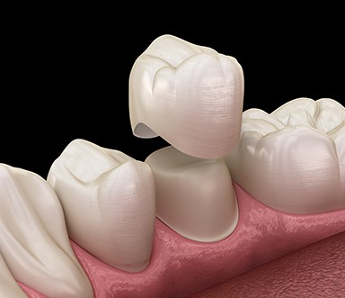 a computer illustration showing how a crown fits over a tooth