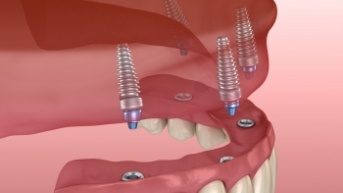 Animated smile during dental implant supported denture placement