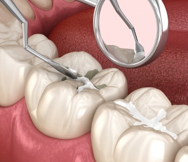 Animated smile during tooth colored filling placement