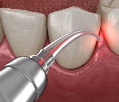 Animated smile during soft tissue laser therapy