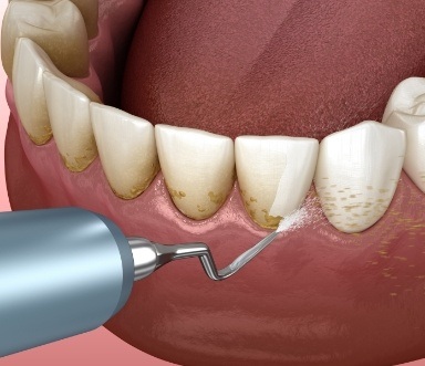 Animated smile during gum disease deep cleaning