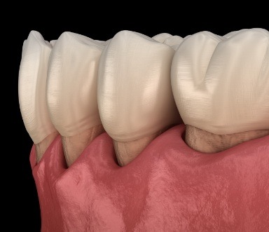 Animated smile with receding gums caused by periodontal disease