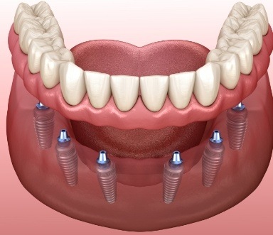 Diagram showing how implant dentures in Burlington work