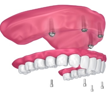 Animated smile depicting the dental implant denture placement procedure
