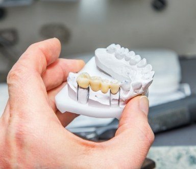 Model smile with dental implant retained fixed bridge