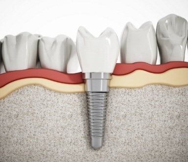 Animated smile with dental implant supported dental crown