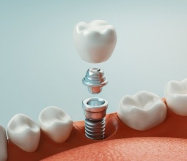 Animated smile during dental implant placement