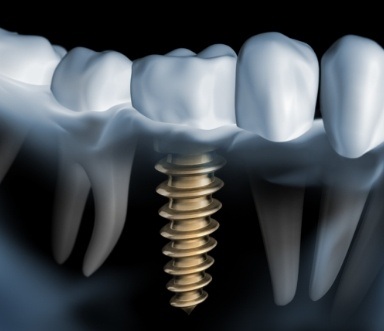 Animated smile representing the four step dental implant process