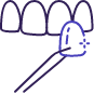 Icon of a veneer being placed over a tooth