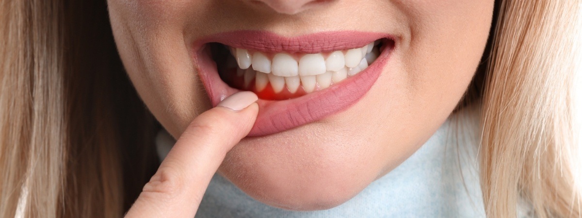 Dental patient pointing to smile before gum recontouring