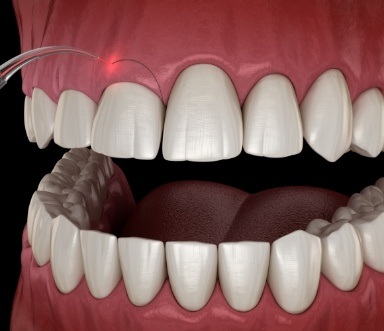 Animated smile during gum recontouring treatment