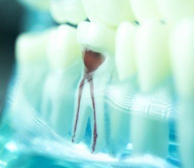 Model smile with tooth with red filling representing root canal therapy