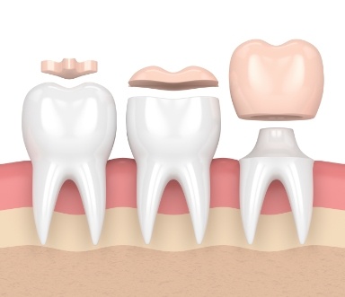 Animated image comparing dental crown to other types of dental restorations
