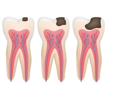 Animated tooth with progressively worse tooth decay before root canal therapy