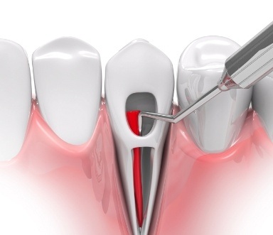 Animated smile during root canal therapy