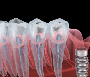 Illustration of a failed dental implant in Burlington, MA