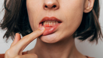 Woman with gum irritation