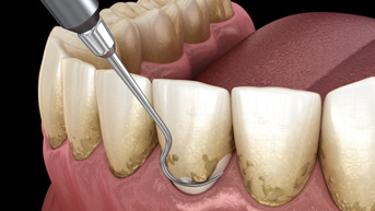 Illustration of scaling of the teeth