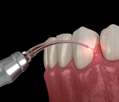 Soft tissue laser dentistry