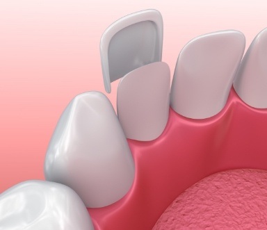 Animated smile during porcelain veneer placement