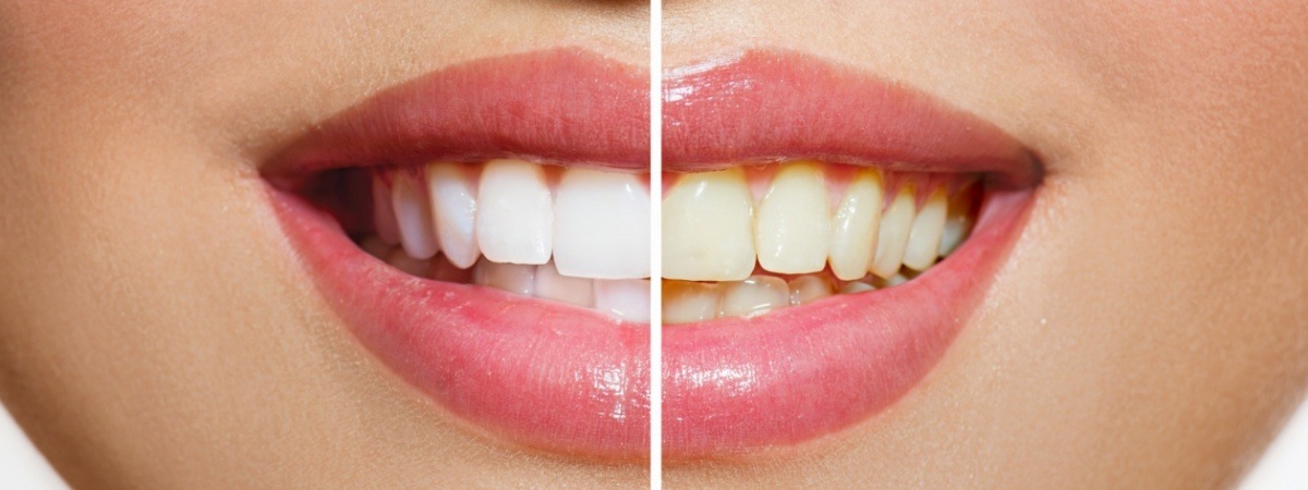 Smile before and after teeth whitening