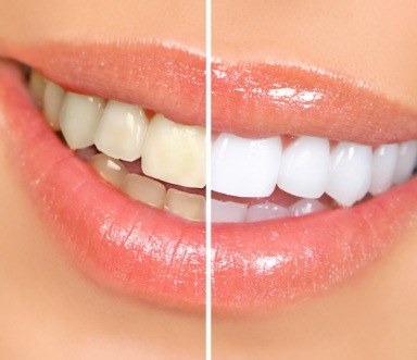 Closeup of smile before and after teeth whitening