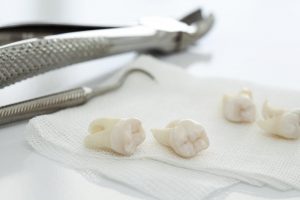 teeth on napkin after tooth extraction in Burlington 