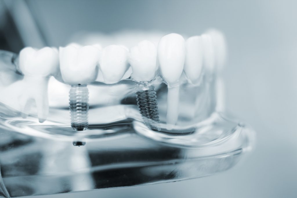 transparent image of dental implants