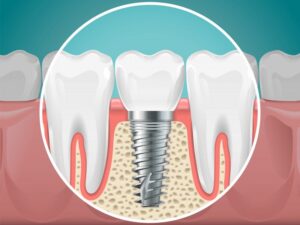 Dental implant.