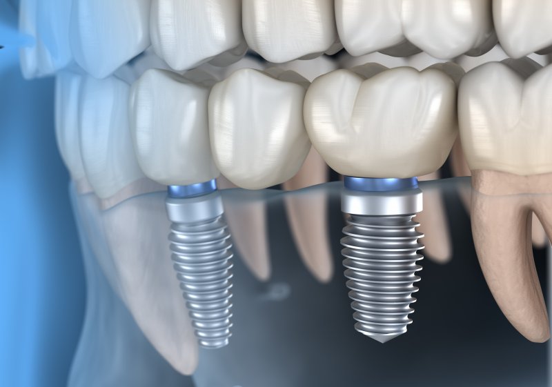 a diagram of a mouth with two dental implants