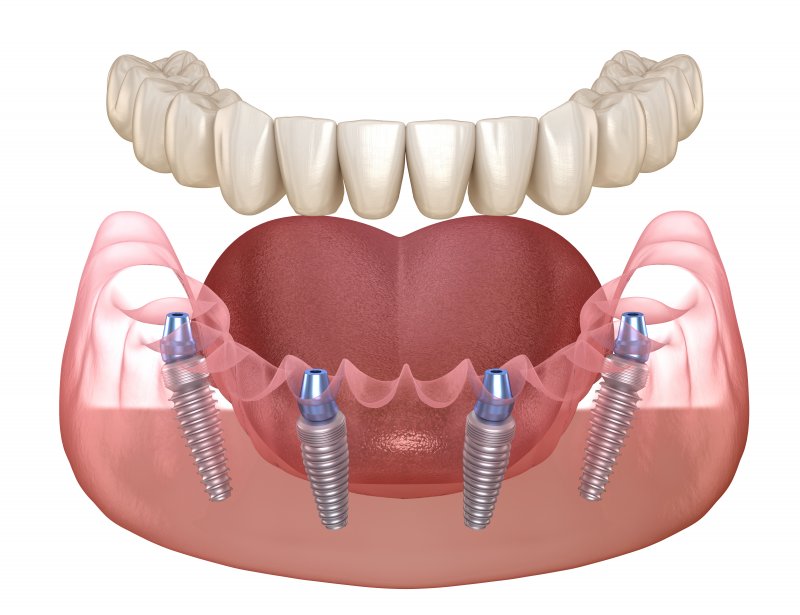 All-on-4 implant system for the lower arch