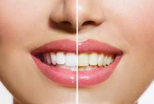 woman before and after teeth whitening