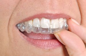 Clear braces in Burlington are a wonderful option for adults. 