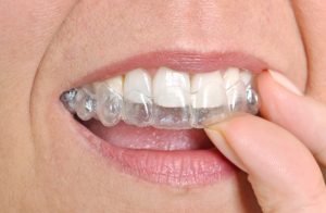 Clear braces in Burlington are a wonderful option for adults. 