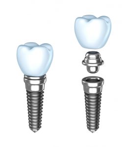 dental implant risks