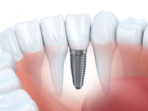 dental implant diagram