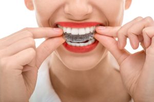 Invisible braces in Burlington