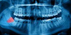 dentist in burlington provides digital x-rays