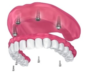 Digital model of implant dentures in Burlington